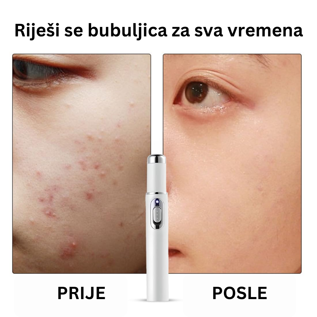 LASERSKA OLOVKA ZA DERMATOLOŠKE PROBLEME